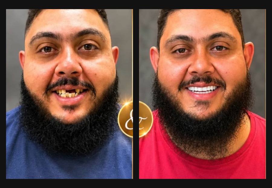 Resultado odontológico antes e depois